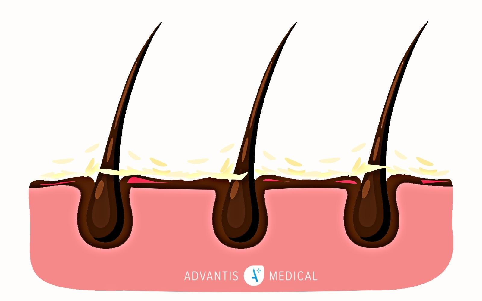 Seborrheic dermatitis diagram on black skin for representation in healthcare.